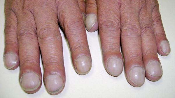 8&nbsp;признаков на&nbsp;руках, которые могут указывать на&nbsp;болезнь