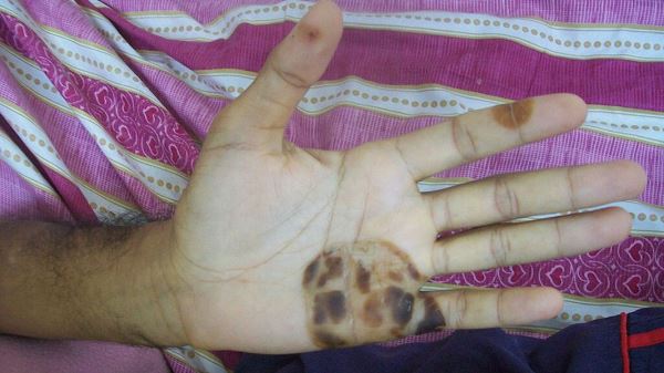 8&nbsp;признаков на&nbsp;руках, которые могут указывать на&nbsp;болезнь