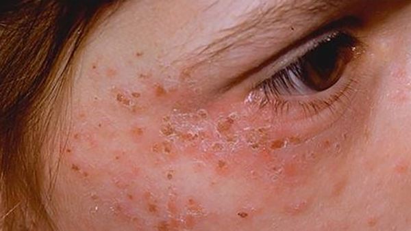 От&nbsp;вампиров до&nbsp;ведьм: болезни, породившие самые страшные мифы